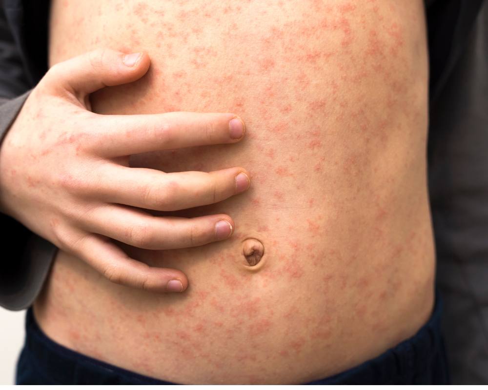 child's stomach covered with measles rash