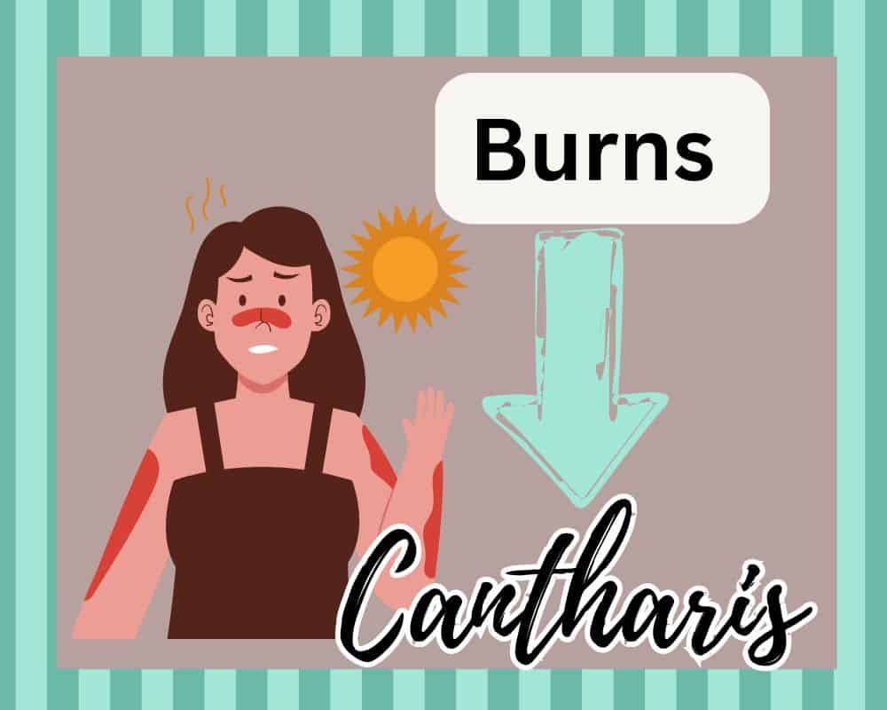 girl with sunburn and cantharis